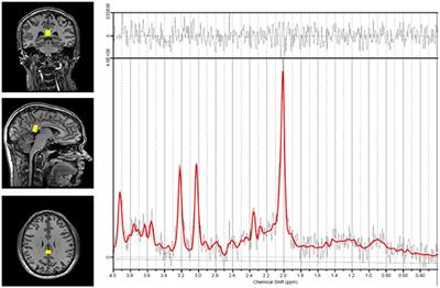 Neuro-Metabolite Changes in a Single Season of University Ice Hockey Using Magnetic Resonance Spectroscopy